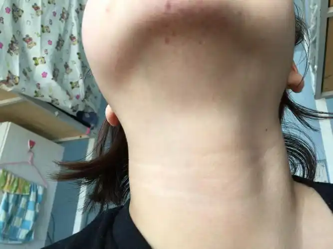 我下巴这是怎么了?不疼不痒