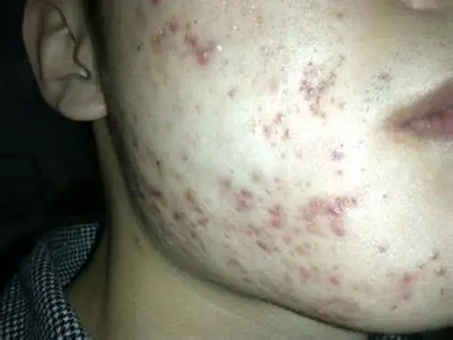 中度寻常性痤疮求图片