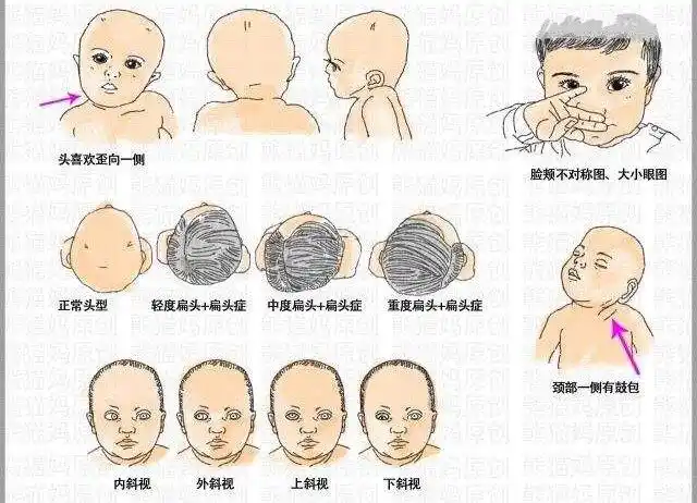 健侧饱满,患侧变小眼睛不在一个正确水平线,严重者导致颈椎侧凸畸形