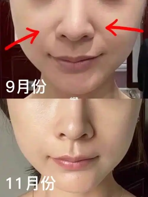 不是智商税这法子淡法令纹真有用