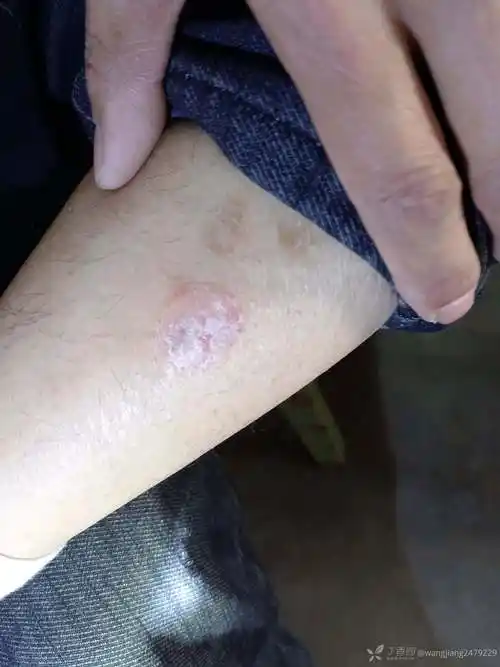 看看什么皮肤病病人好几年了最近变大了不痒脱皮事有时候流点清水
