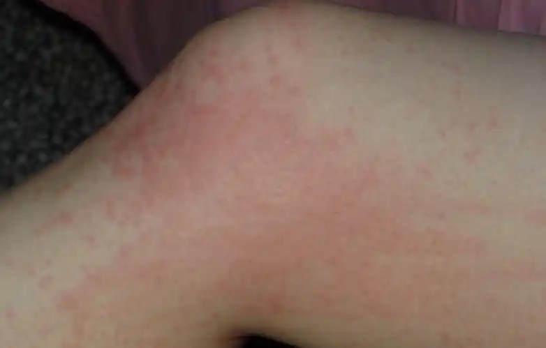 这是皮肤过敏还是荨麻疹?