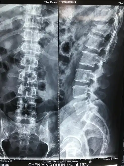 胸12椎体骨折屈曲牵张型损伤