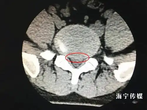 小张的ct红色圈内为突出的椎间盘