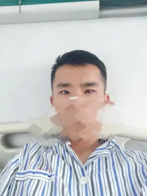 斜视手术后第二天