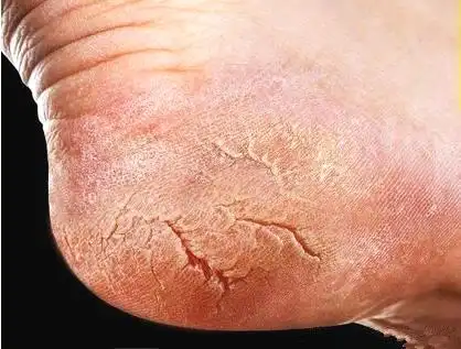 冬天脚部脱皮干裂怎么办?每天擦点"它",脚后跟又白又水嫩