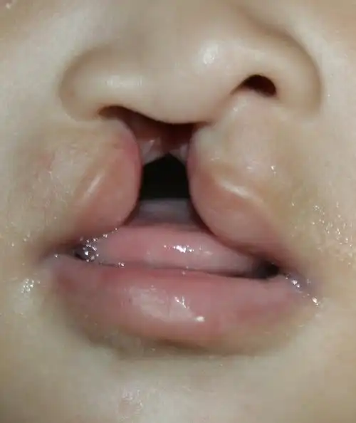 先天性唇裂如何治疗?_唇腭裂_唇腭裂治疗方式 - 好大夫在线