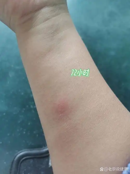 72小时ppd皮试,一般阳性 医生说问题不大,不用治疗,可以备孕 这三天真