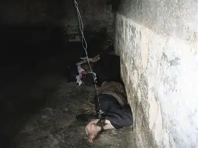 朱双喜双脚被锁了10年,脚踝处磨出了茧子.杨龙/摄