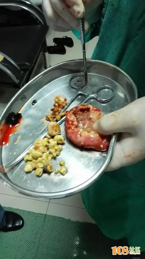 关注老人健康,巨化取胆拿出多颗结石有胆看吗?慎点