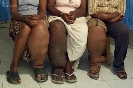 丝虫病的症状图片,丝虫病图片大全_丝虫病_39疾病百科