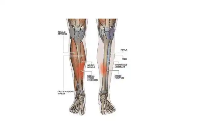 跑完步不光小腿疼迎面骨前侧也疼很可能是它的原因