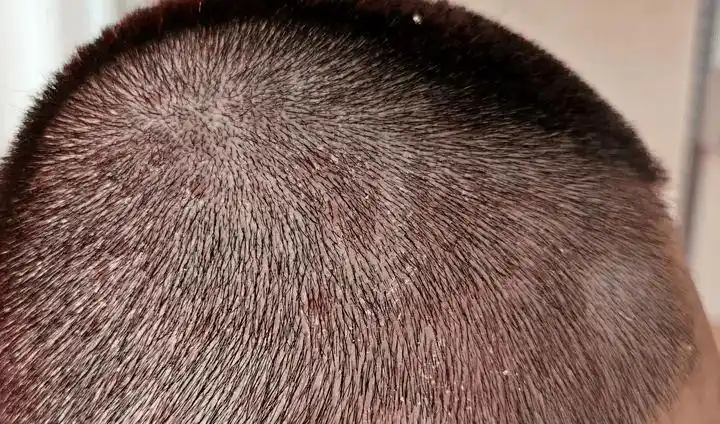 头皮脂溢性皮炎怎么治疗