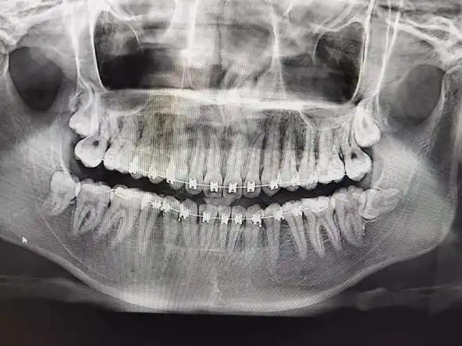 半夜睡不着刷到这个神奇小组分享一下我的牙片