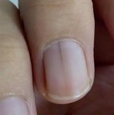 甲母痣早期图片 (32)_有来医生