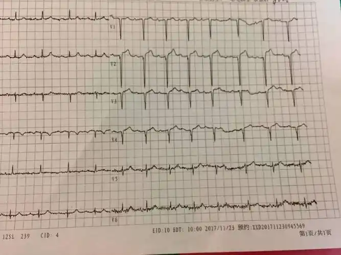 Ⅵ一Ⅴ4导联异常q波是什么意思?