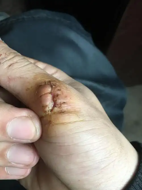 拆线了发现伤口这种样子,还能愈合到一起嘛 伤口左边好像已经陷下去了