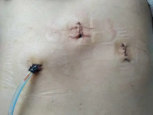 小创伤,轻疼痛---4k微创去病痛