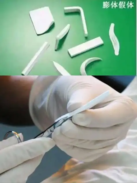 膨体材料医生雕刻示意图