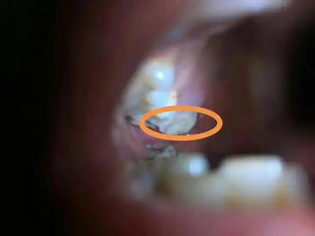 拔右上智齿第三天,忽然发现原来智齿位置有个乳白色肉块,有臭味,咬合