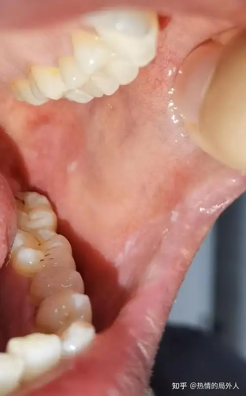 口腔扁平苔藓求医记