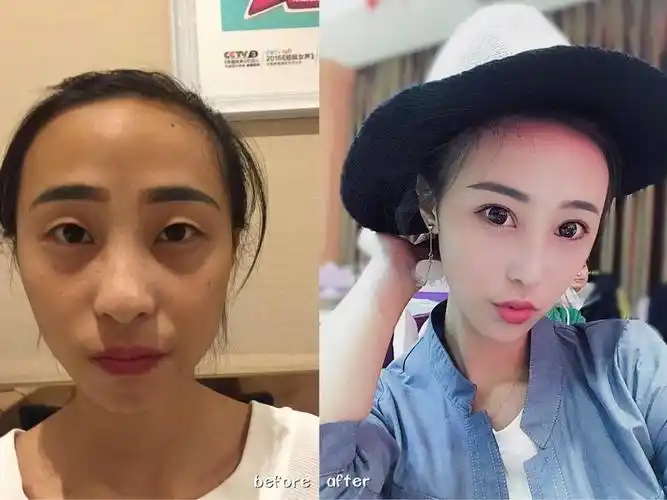 哪些人不适合做双眼皮?