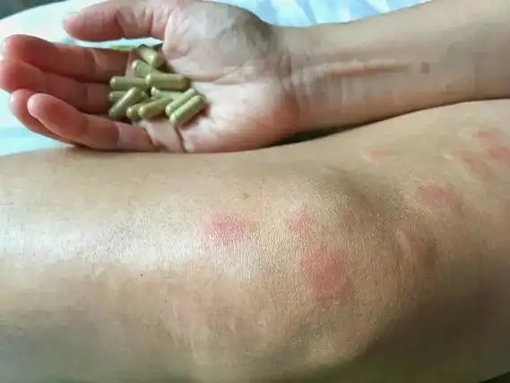 有没有红斑狼疮生完孩子后痊愈的案例?_家庭医生在线