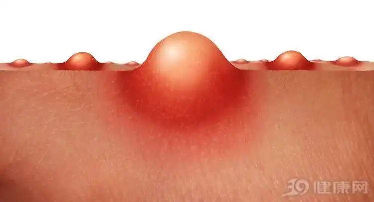 女性hpv初期症状图片大全(感染hpv后,身体会有什么表现?) - x迷电脑网