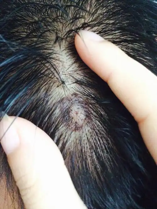 我老公头顶处长了一个血红色的肉球疙瘩发现差不多3个多月最