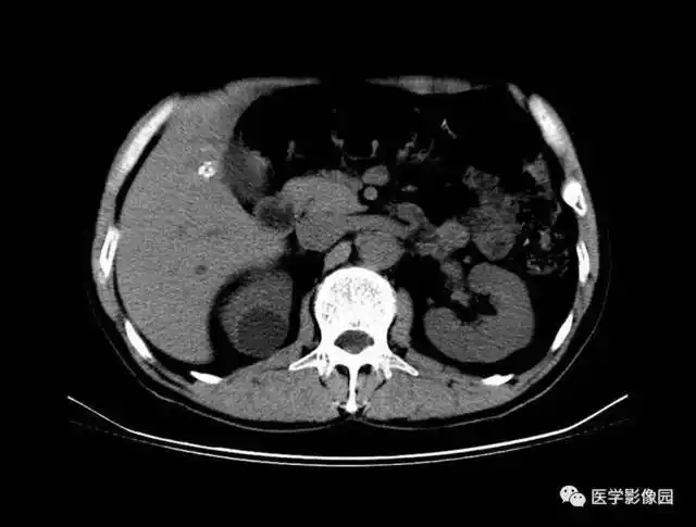 泌尿生殖系统 第二节 泌尿系统病变 五,泌尿系统畸形(七)单纯性肾囊肿