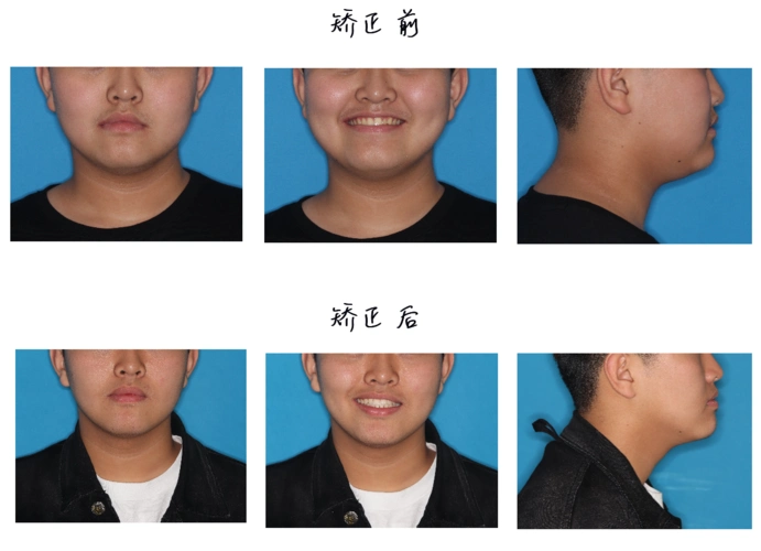 矫正前后口内像对比预约同款医生王特贝致案例库