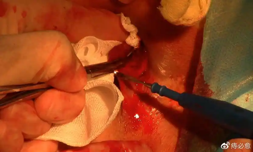 惊人的痔疮手术真相