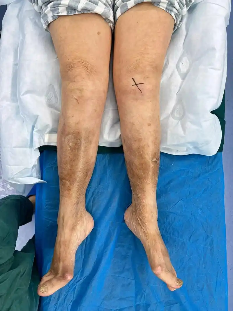 双膝类风湿关节炎 膝关节外翻畸形,即严重x型腿!较普通 - 抖音