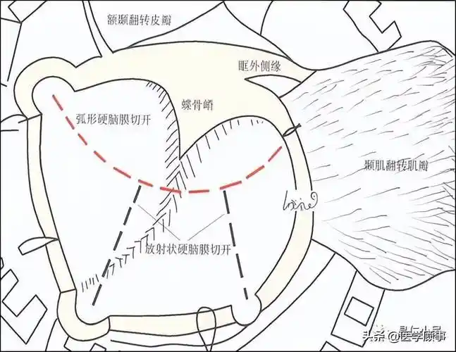 神经外科手术入路解剖翼点入路