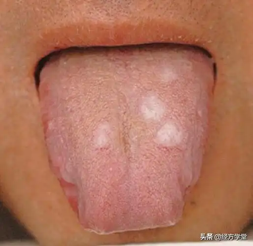 舌象容易受年龄,性别,饮食,体质,地域,时间,生理周