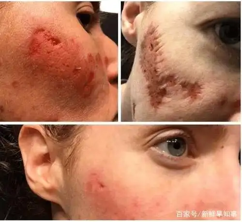 女子公厕用皂液洗手 脸部腐烂现坑洞如僵尸上脸