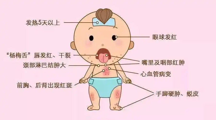 小儿麻疹知识大科普