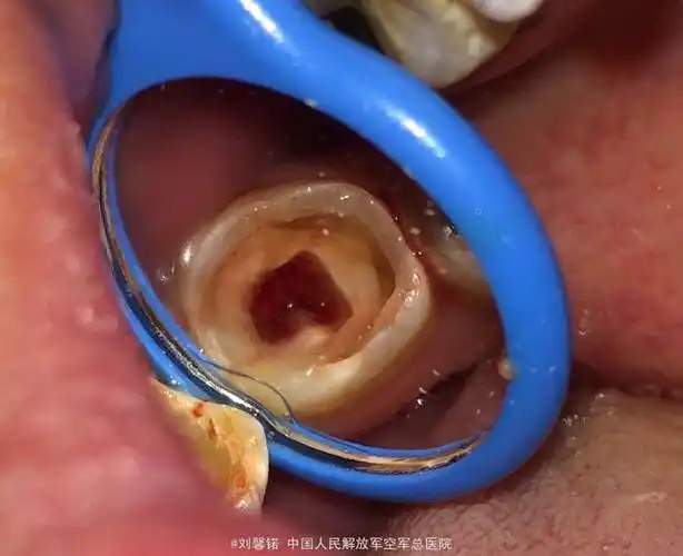 下7c型根管治疗一例