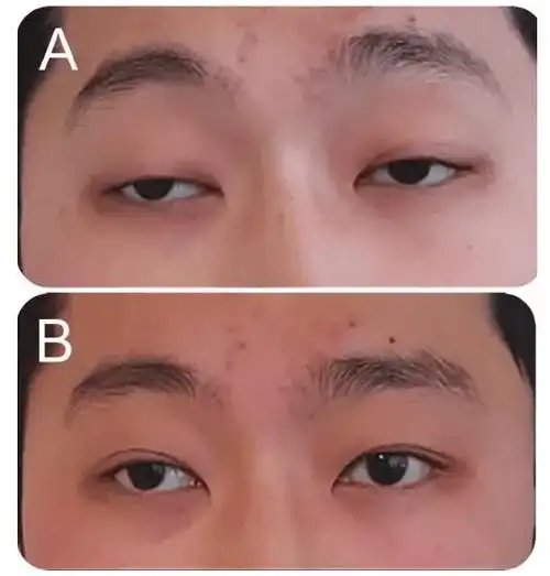 上眼睑无力是怎么回事