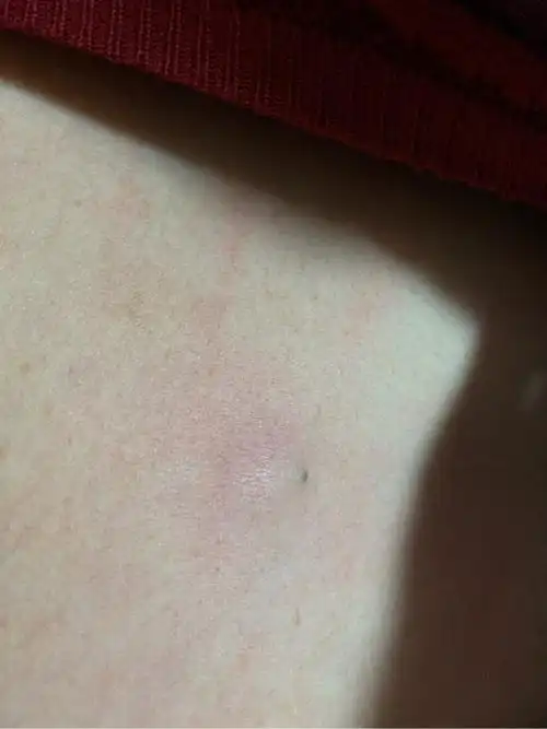 弥漫大b八疗结束二个月今天发现胸部有个小硬块