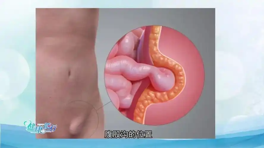 健康随行丨勿以"疝"小而不为|疝气|健康随行_新浪新闻