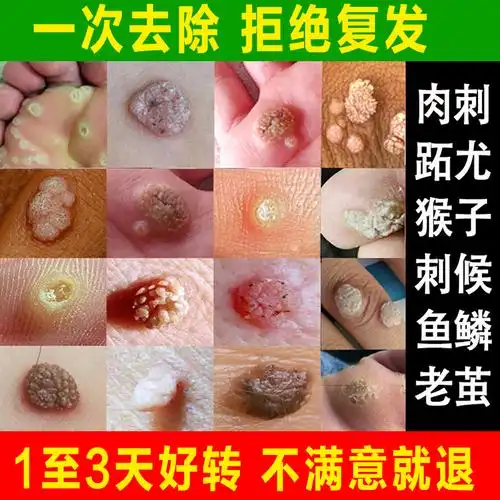 刺猴去除正品膏贴足部脚底肉粒疙瘩去老茧跖疣02瘊子鱼鳞痦子肉痣好