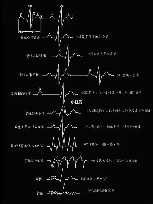 一张图教你看懂心电图7575