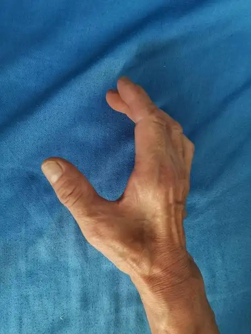 手部麻木肌肉萎缩-肘管综合征