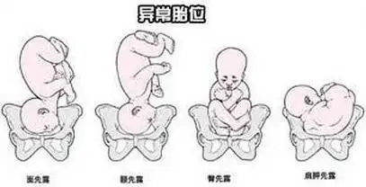 头部是胎儿身体当中最大的部位,俗语说:"头过身就过",所以头位较能