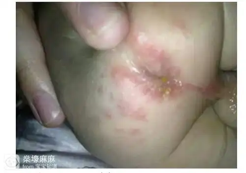 【夏日大作战】夏天尿布疹,痱子护理