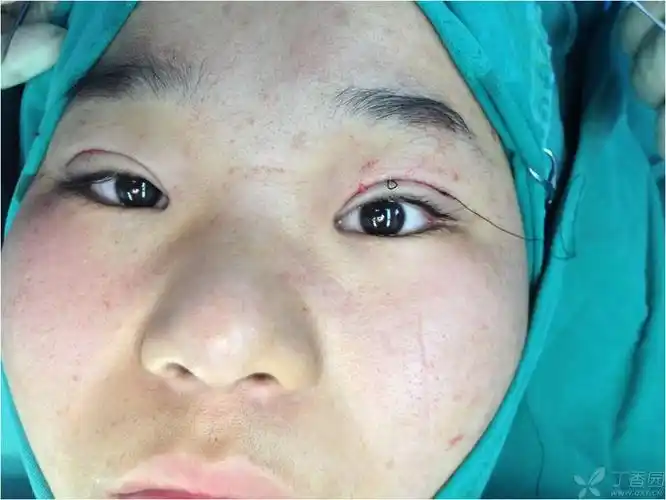 【讨论】单纯上睑提肌腱膜缩短矫正上睑下垂 [病例帖]
