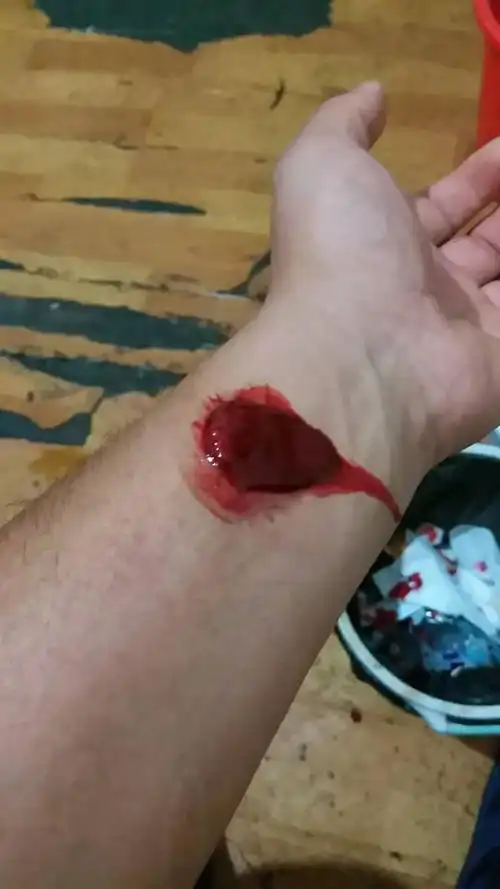 美容院竹刺络排毒好像跟拔罐差不多拔出来的血都凝固的说是淤血这个是