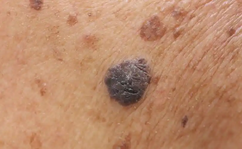 皮肤异常瘙痒,颜色改变,别当成普通病_癌症_症状_患者