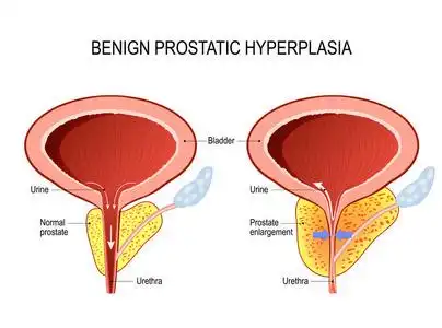 良性前列腺增生症 (bph).前列腺肿大照片